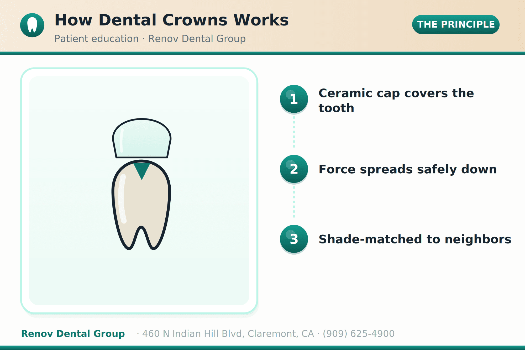 Dental Crowns in Claremont