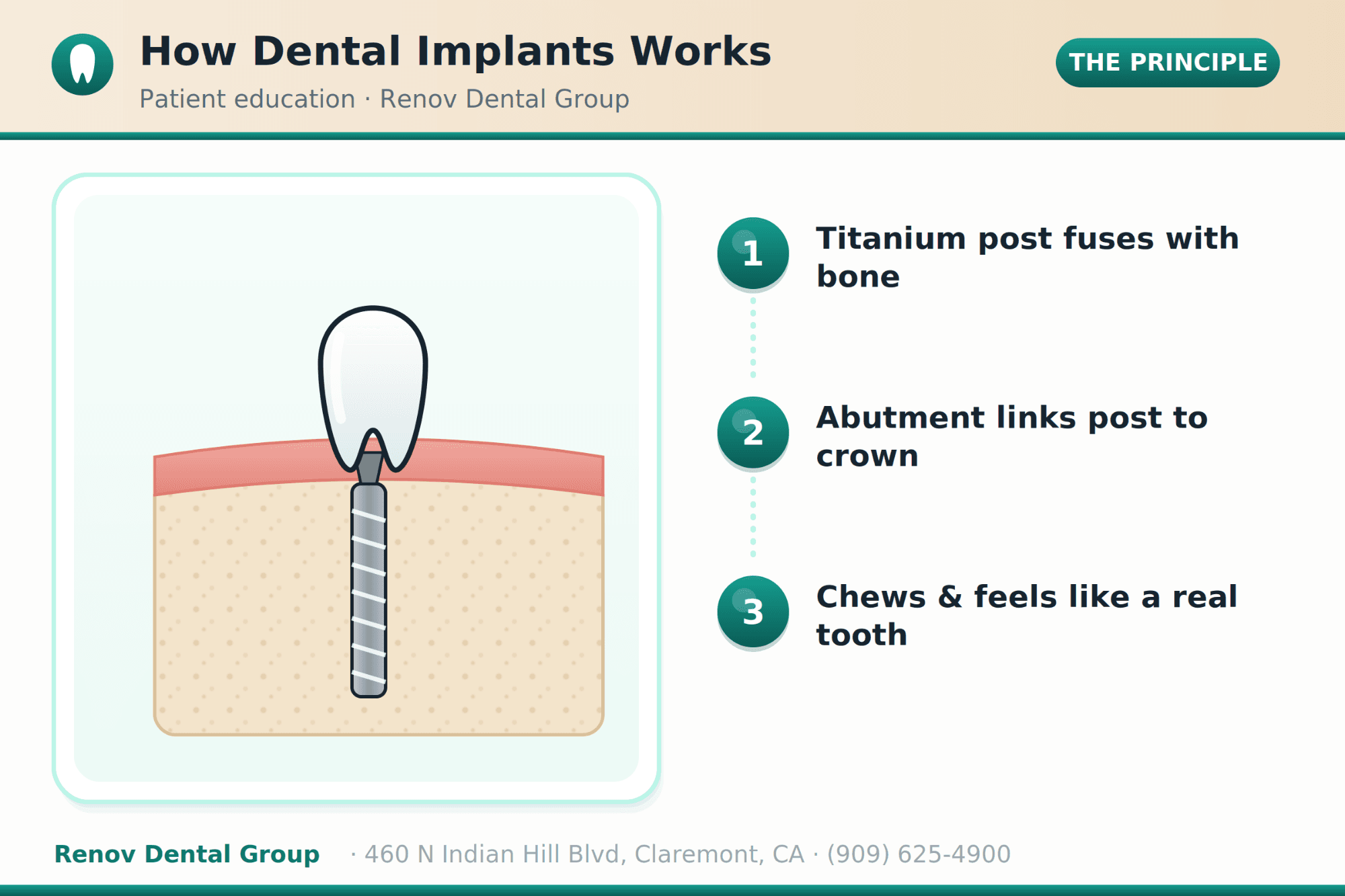 Dental Implants in Claremont